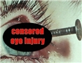 A censored eye injury that occurred because the victim did not follow their eye safety training